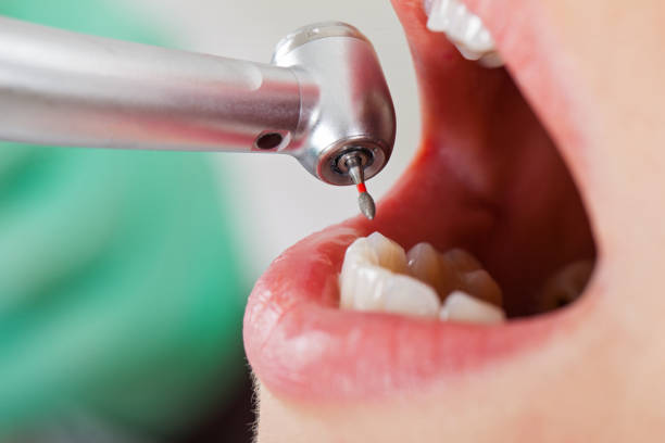 Best Emergency Dental Care for Broken or Chipped Teeth in Huntsville, MO